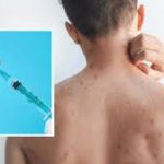 Minsal refuerza control sanitario en todo el país por brote de sarampión en Perú